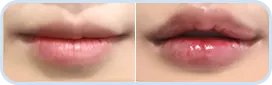 Lip corners + lip filler