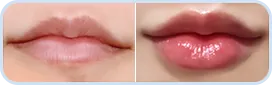 Lip corners + lip filler