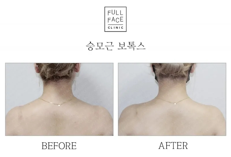 승모근보톡스(21.6.10→21.9.9)