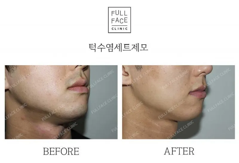 턱수염세트제모(25.5.6→25.7.27)