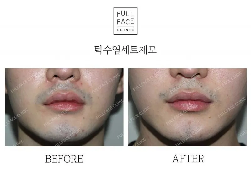 턱수염세트제모(25.5.6→25.7.27)