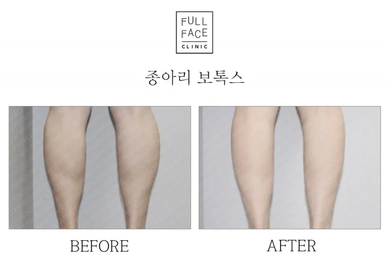 종아리보톡스(20.2.5→20.3.24)